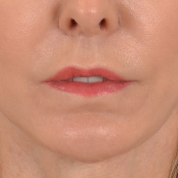 Lip Lift Before & After Gallery - Patient 157502 - Image 2