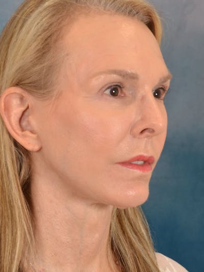 Brow Lift Before & After Gallery - Patient 403225 - Image 4