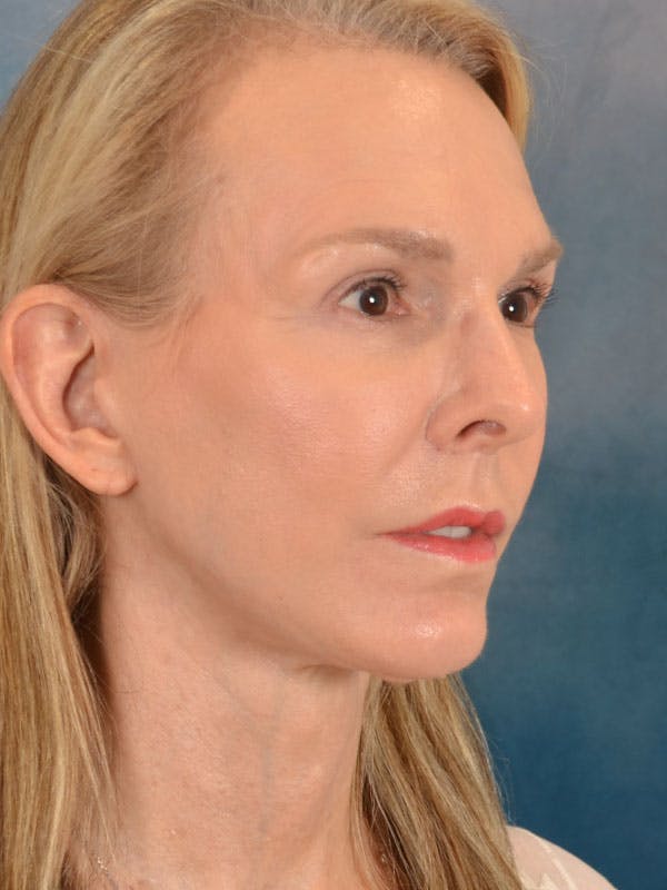 Brow Lift Before & After Gallery - Patient 403225 - Image 4