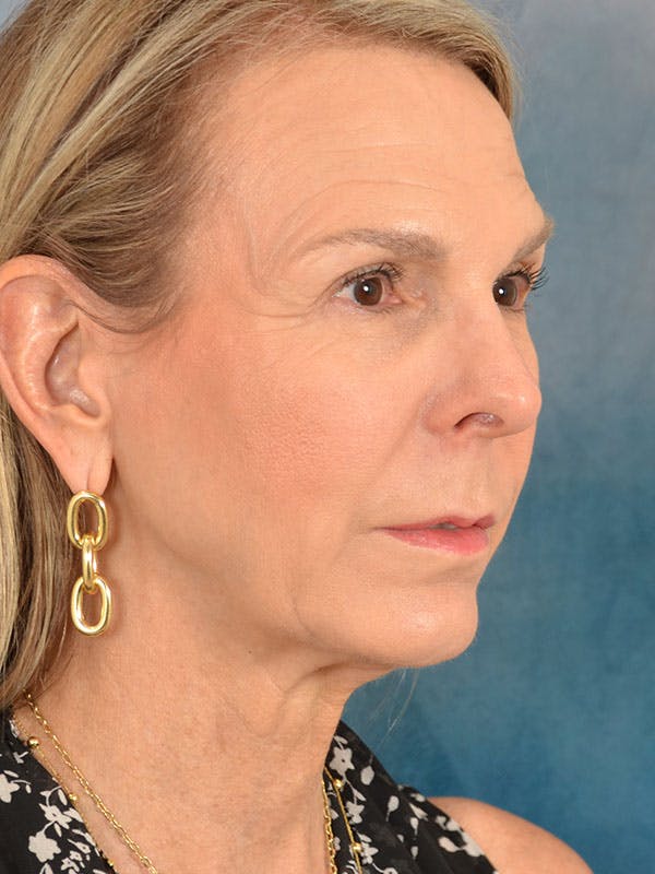 Brow Lift Before & After Gallery - Patient 403225 - Image 3