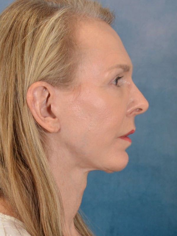 Brow Lift Before & After Gallery - Patient 403225 - Image 6
