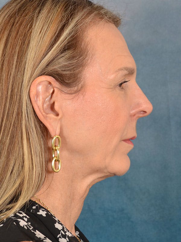 Brow Lift Before & After Gallery - Patient 403225 - Image 5
