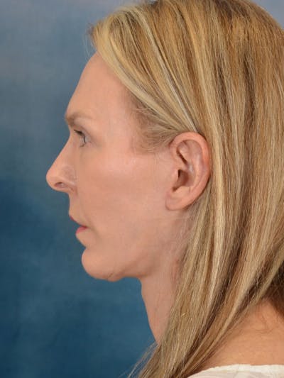 Brow Lift Before & After Gallery - Patient 403225 - Image 8