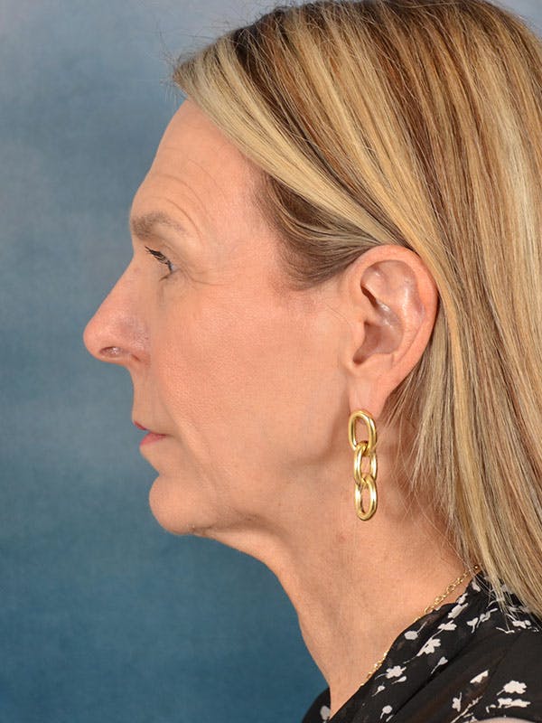Brow Lift Before & After Gallery - Patient 403225 - Image 7