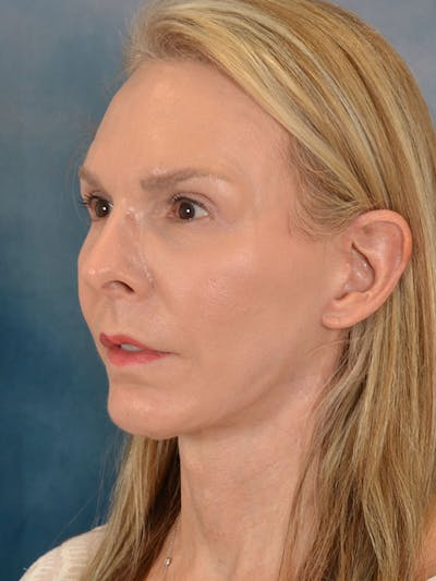 Earlobe Repair Before & After Gallery - Patient 342144 - Image 2