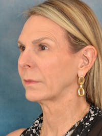 Deep Plane Facelift Before & After Gallery - Patient 400362 - Image 1