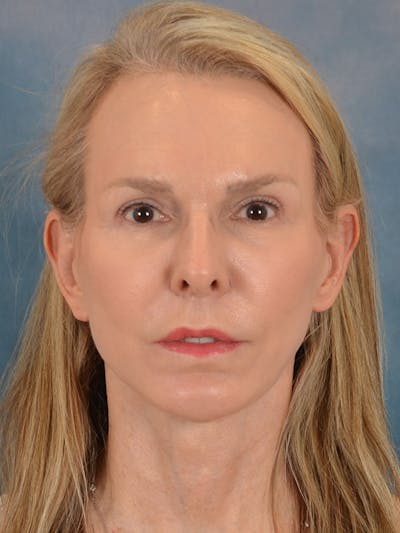 Laser Skin Resurfacing Before & After Gallery - Patient 291120 - Image 2
