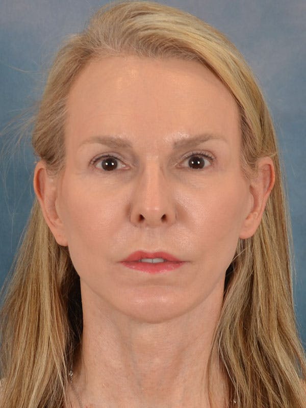 Brow Lift Before & After Gallery - Patient 403225 - Image 2