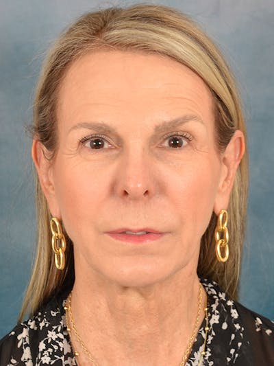 Laser Skin Resurfacing Before & After Gallery - Patient 291120 - Image 1