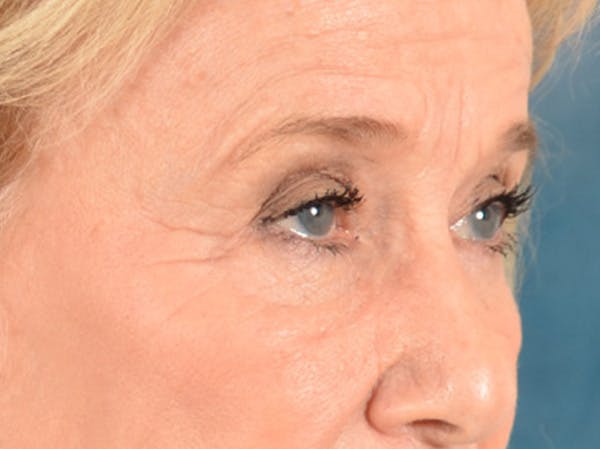 Eyelid Lift Before & After Gallery - Patient 162759 - Image 3