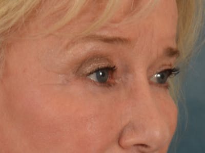 Eyelid Lift Before & After Gallery - Patient 162759 - Image 4