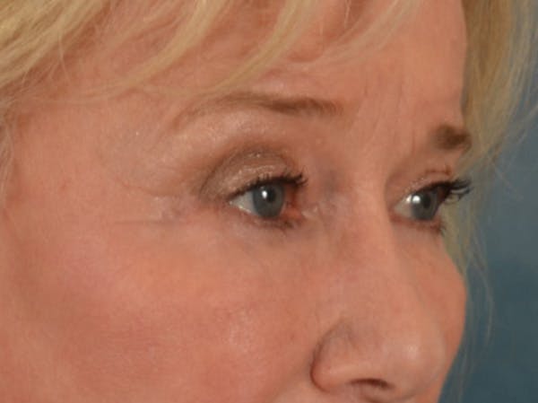 Eyelid Lift Before & After Gallery - Patient 162759 - Image 4