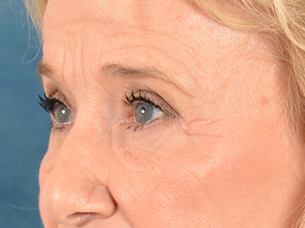 Eyelid Lift Before & After Gallery - Patient 162759 - Image 7