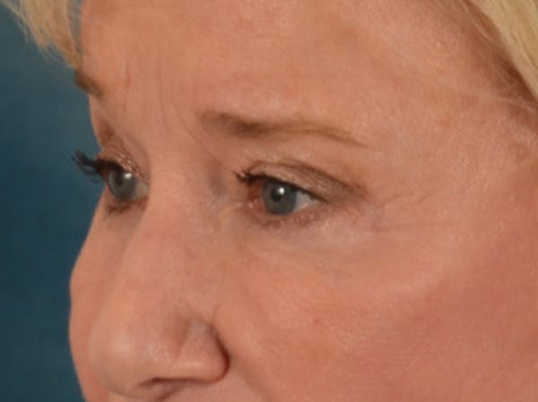 Eyelid Lift Before & After Gallery - Patient 162759 - Image 8