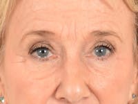 Eyelid Lift Before & After Gallery - Patient 162759 - Image 1