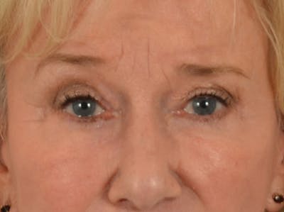 Eyelid Lift Before & After Gallery - Patient 162759 - Image 2