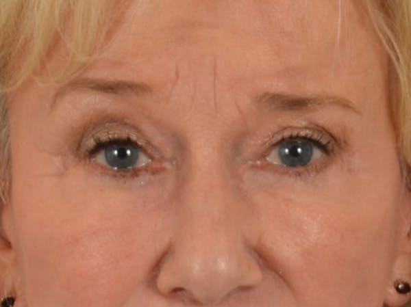 Eyelid Lift Before & After Gallery - Patient 162759 - Image 2