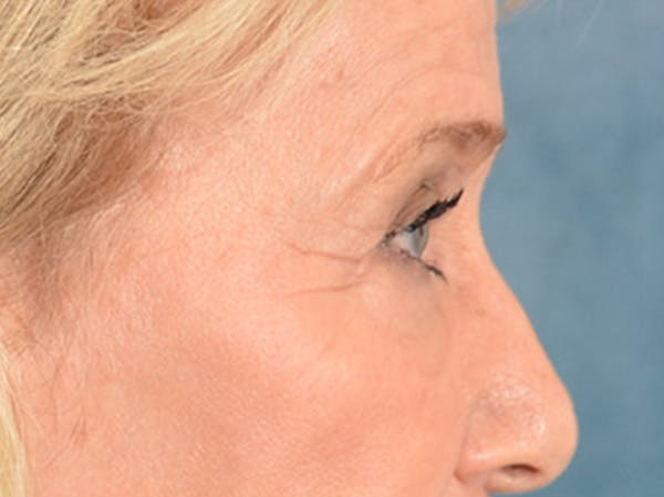 Eyelid Lift Before & After Gallery - Patient 162759 - Image 5