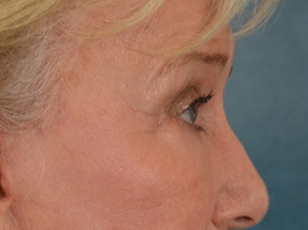Eyelid Lift Before & After Gallery - Patient 162759 - Image 6
