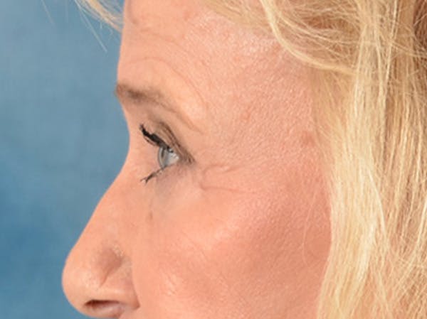Eyelid Lift Before & After Gallery - Patient 162759 - Image 9