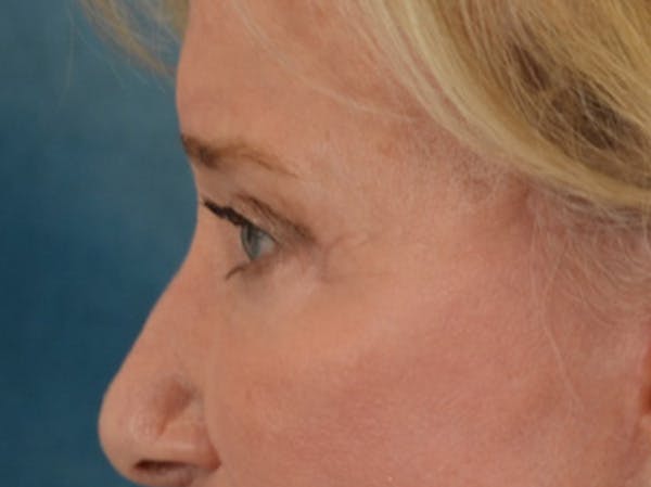 Eyelid Lift Before & After Gallery - Patient 162759 - Image 10