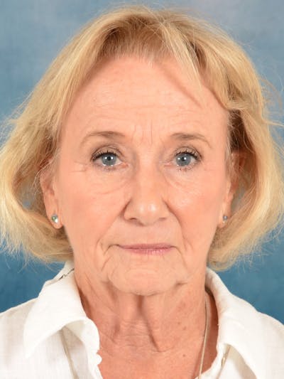 Laser Skin Resurfacing Before & After Gallery - Patient 203241 - Image 1