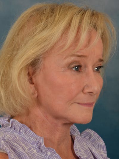 Laser Skin Resurfacing Before & After Gallery - Patient 203241 - Image 4