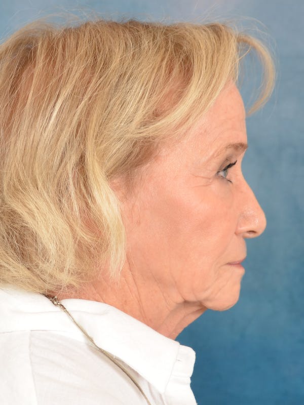 Laser Skin Resurfacing Before & After Gallery - Patient 203241 - Image 5
