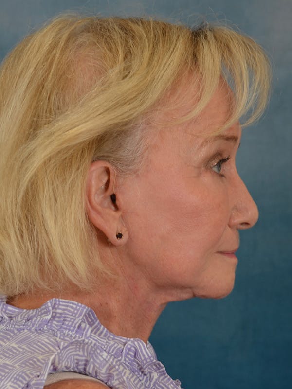Laser Skin Resurfacing Before & After Gallery - Patient 203241 - Image 6