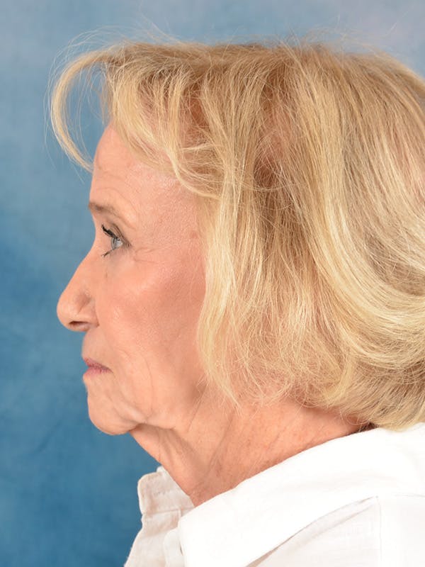 Laser Skin Resurfacing Before & After Gallery - Patient 203241 - Image 9