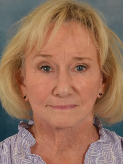 Laser Skin Resurfacing Before & After Gallery - Patient 203241 - Image 2