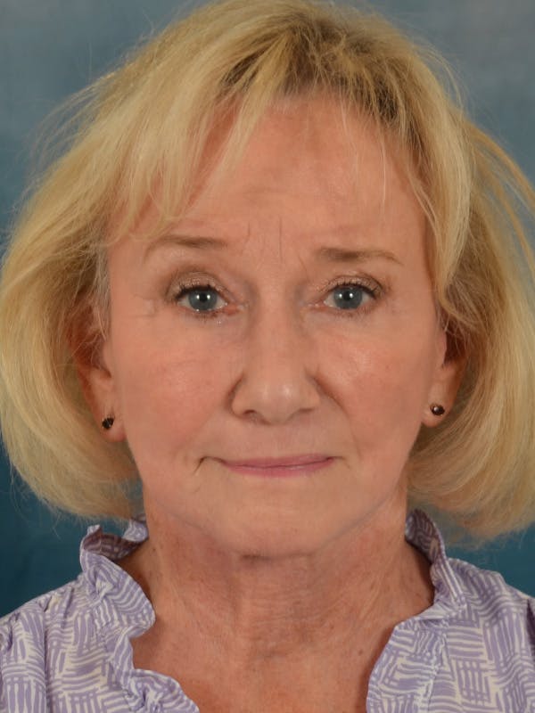 Laser Skin Resurfacing Before & After Gallery - Patient 203241 - Image 2