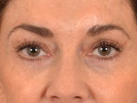 Eyelid Lift Before & After Gallery - Patient 605393 - Image 1