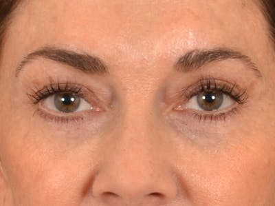 Eyelid Lift Before & After Gallery - Patient 605393 - Image 1