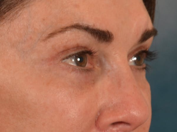 Eyelid Lift Before & After Gallery - Patient 605393 - Image 4