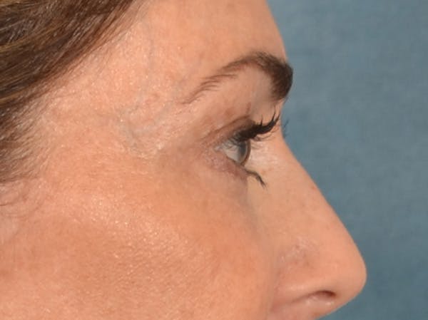 Eyelid Lift Before & After Gallery - Patient 605393 - Image 5