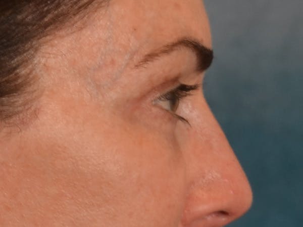 Eyelid Lift Before & After Gallery - Patient 605393 - Image 6