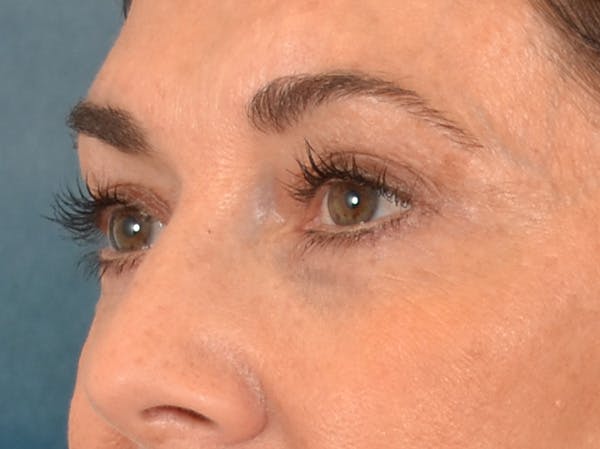 Eyelid Lift Before & After Gallery - Patient 605393 - Image 7