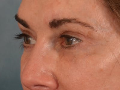 Eyelid Lift Before & After Gallery - Patient 605393 - Image 8