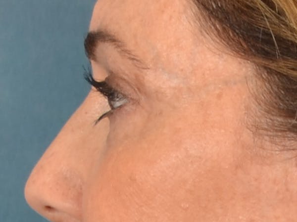 Eyelid Lift Before & After Gallery - Patient 605393 - Image 9