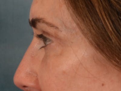Eyelid Lift Before & After Gallery - Patient 605393 - Image 10