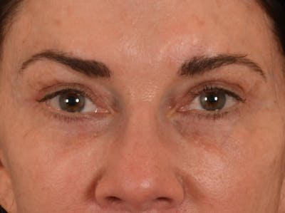 Eyelid Lift Before & After Gallery - Patient 605393 - Image 2