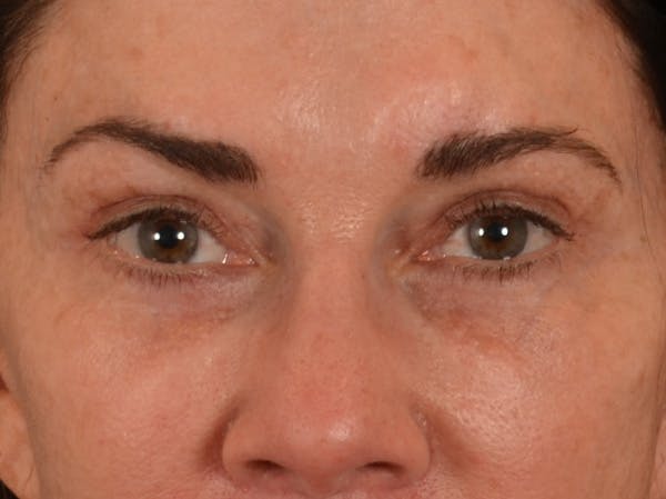 Eyelid Lift Before & After Gallery - Patient 605393 - Image 2