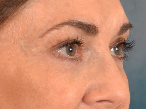 Eyelid Lift Before & After Gallery - Patient 605393 - Image 3