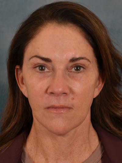Laser Skin Resurfacing Before & After Gallery - Patient 303991 - Image 2