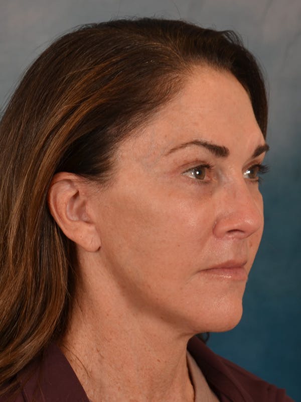 Laser Skin Resurfacing Before & After Gallery - Patient 303991 - Image 4