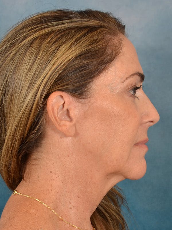 Laser Skin Resurfacing Before & After Gallery - Patient 303991 - Image 7