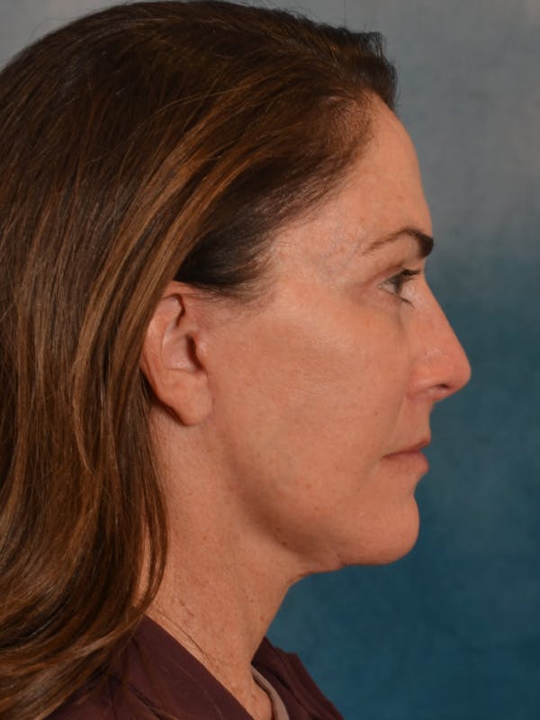 Laser Skin Resurfacing Before & After Gallery - Patient 303991 - Image 8