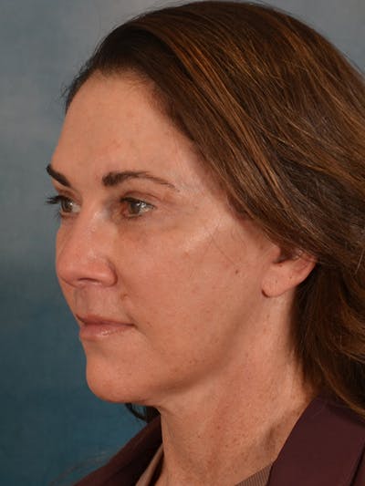 Laser Skin Resurfacing Before & After Gallery - Patient 303991 - Image 6