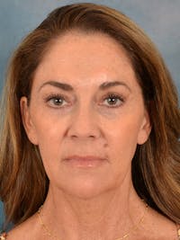 Laser Skin Resurfacing Before & After Gallery - Patient 303991 - Image 1